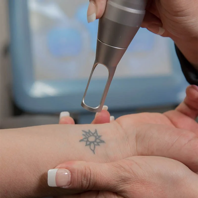 Eliminación de Tatuajes en Les Tres Torres